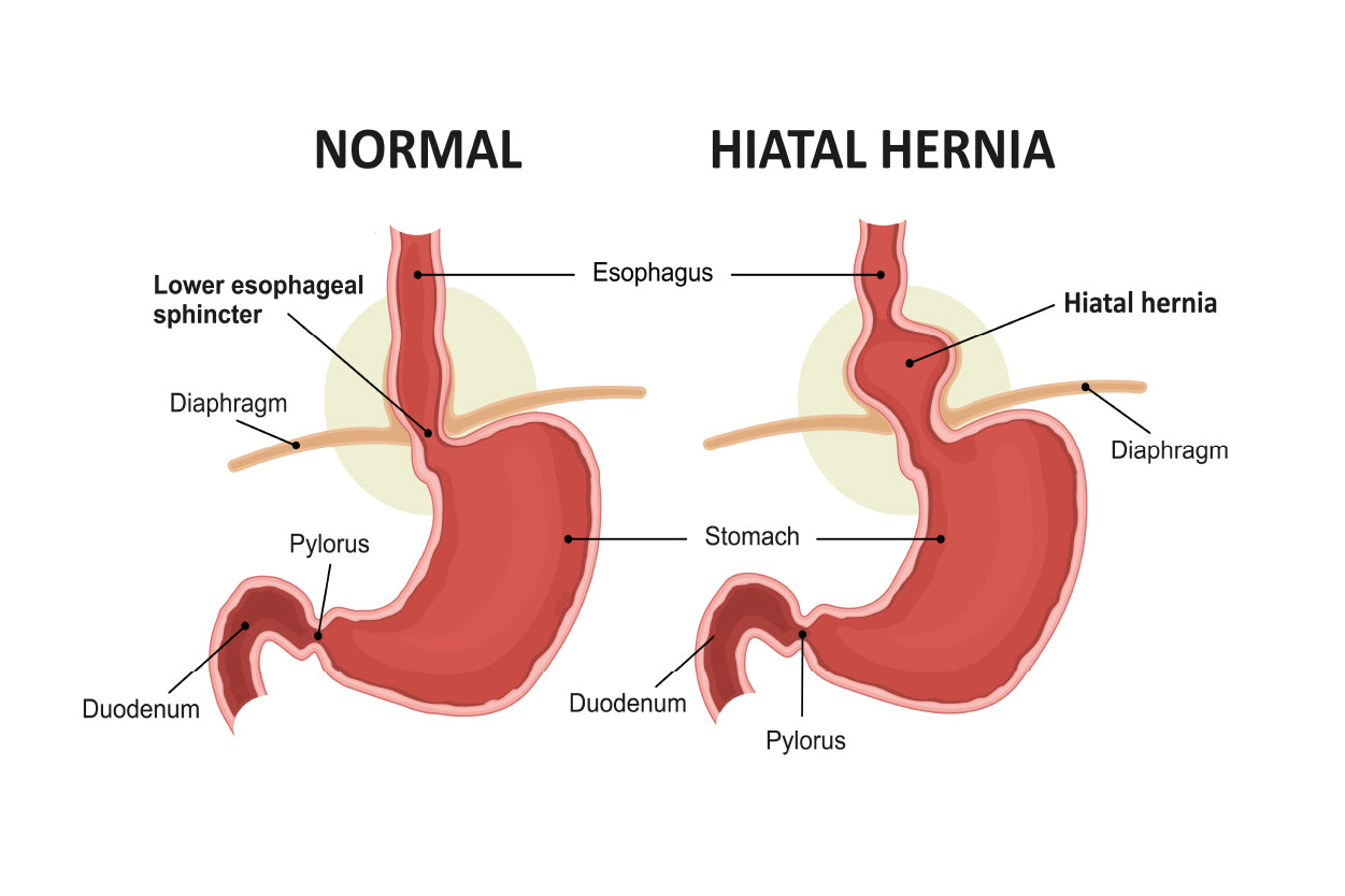 Hiatal Hernia & Normal Anatomy of The Stomach Home Decor Premium Quality Poster Print Choose Your Sizes - Bella Home Decor