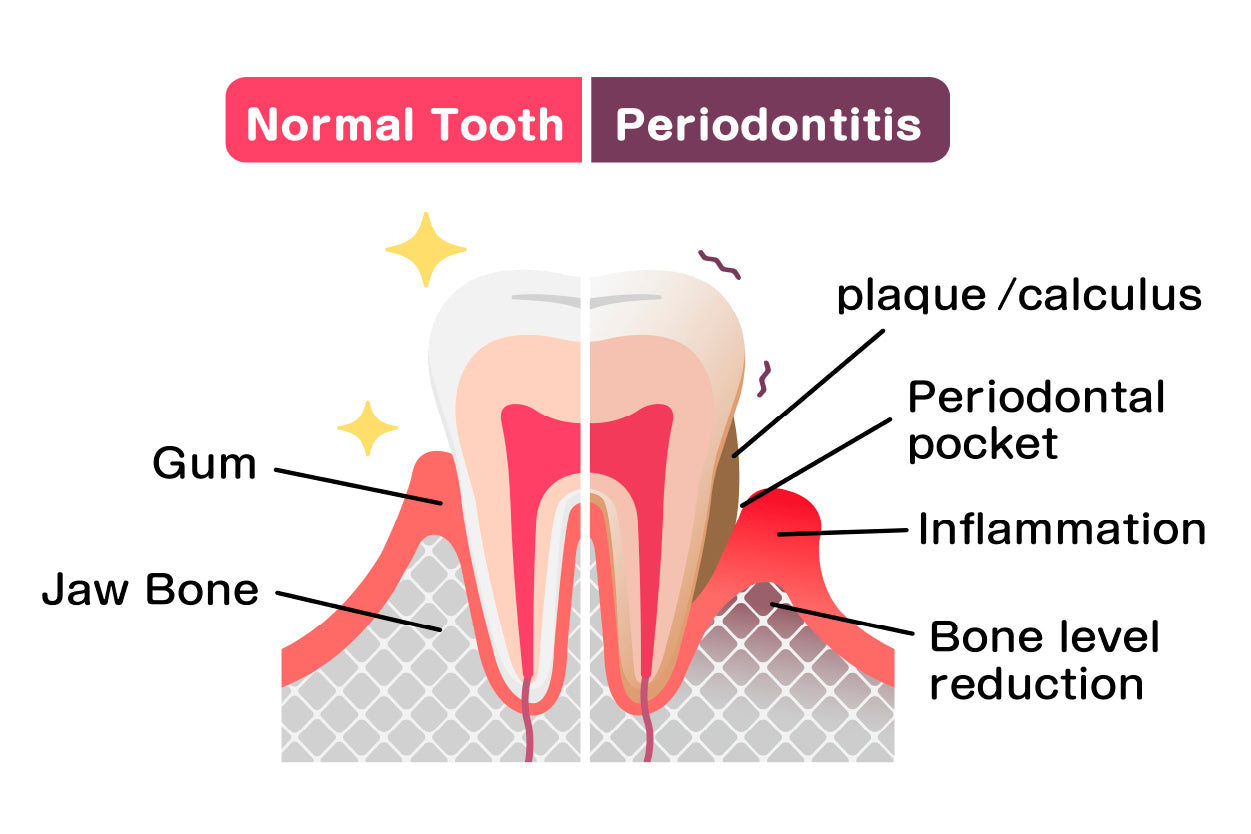 Normal Teeth & Periodontal Disease Home Decor Premium Quality Poster Print Choose Your Sizes - Bella Home Decor