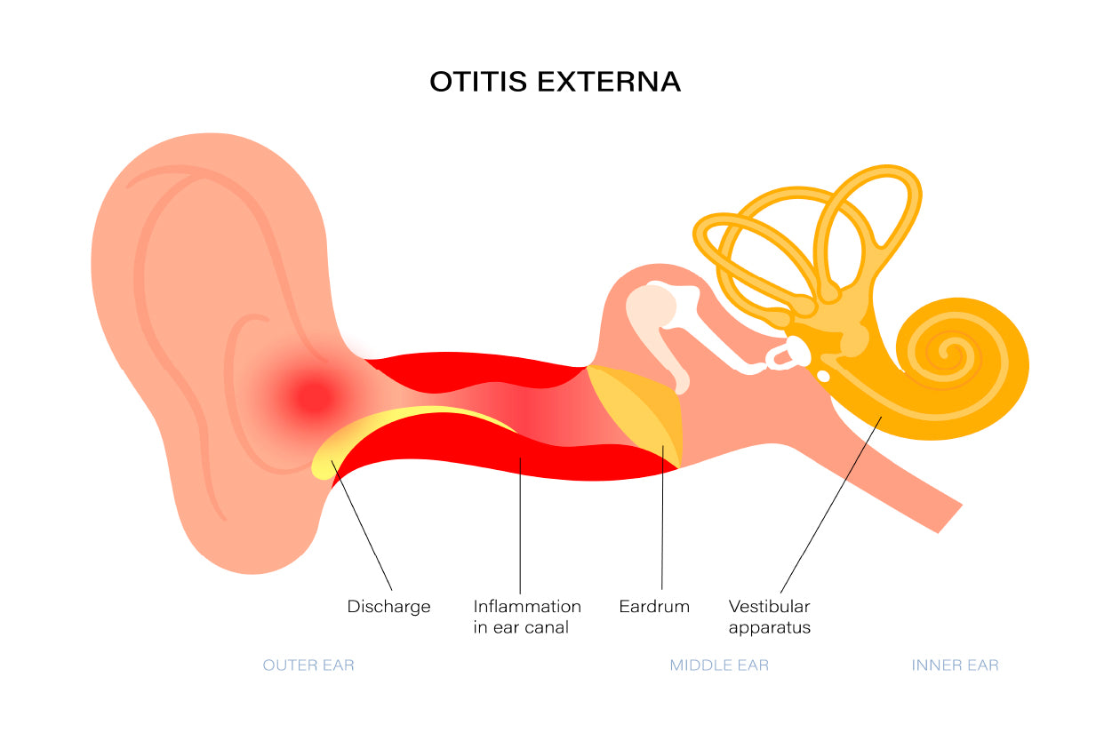 Swimmers Ear Otitis Illustration Home Decor Premium Quality Poster Print Choose Your Sizes - Bella Home Decor