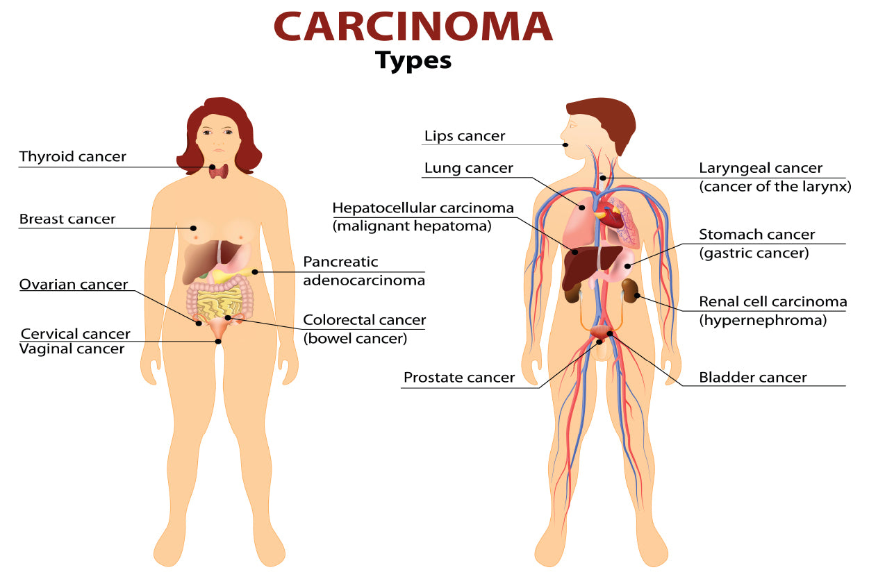 Carcinoma Illustration Home Decor Premium Quality Poster Print Choose Your Sizes - Bella Home Decor