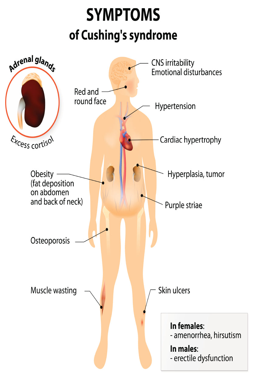 Cushing’s Disease and Syndrome Illustration Home Decor Premium Quality Poster Print Choose Your Sizes - Bella Home Decor
