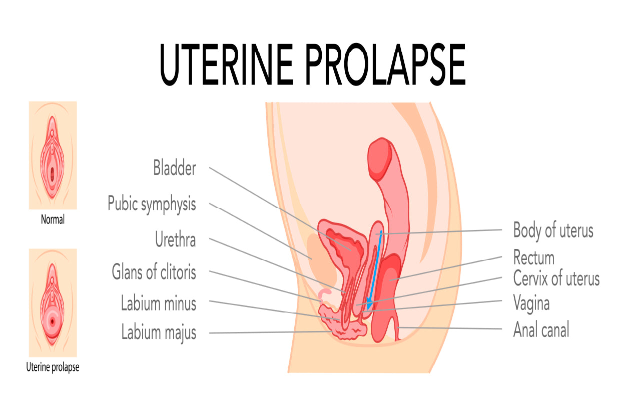 Uterine Prolapse Female Reproductive System Home Decor Premium Quality Poster Print Choose Your Sizes - Bella Home Decor