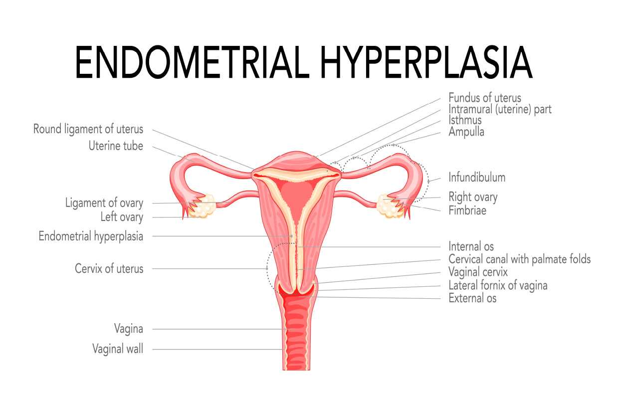 Endometrial Hyperplasia, Medical Diagram Home Decor Premium Quality Poster Print Choose Your Sizes - Bella Home Decor