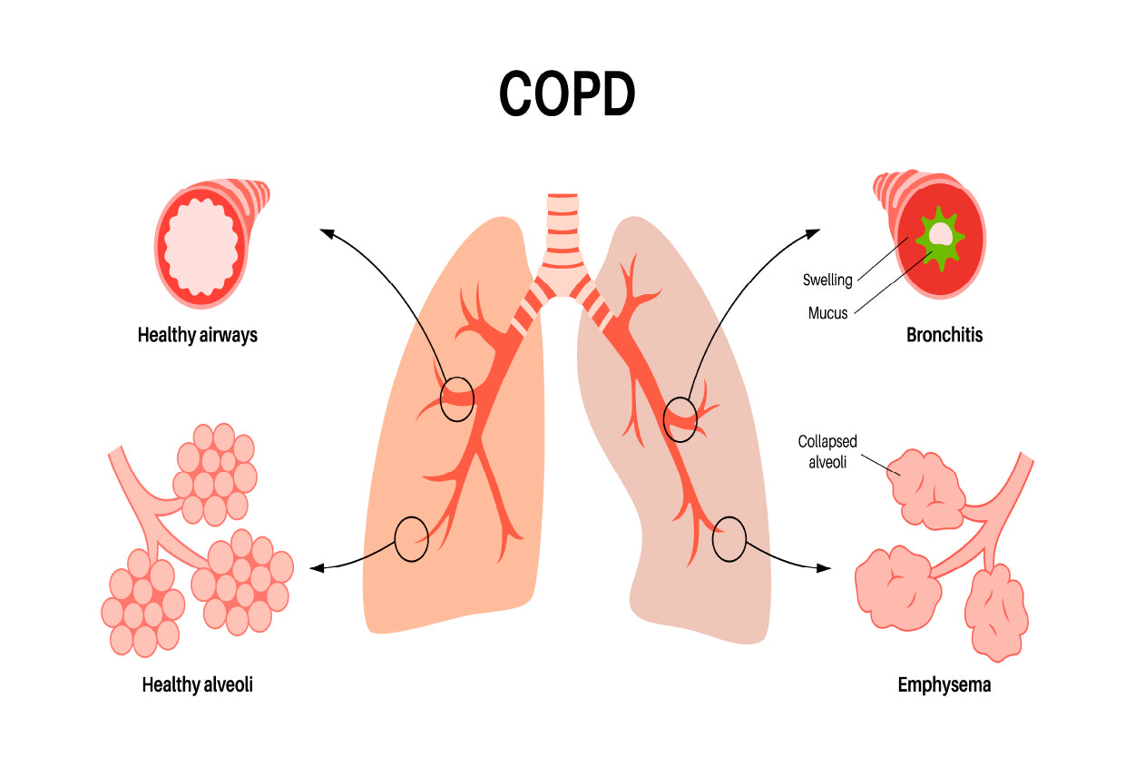 Chronic Obstructive Pulmonary Disease Home Decor Premium Quality Poster Print Choose Your Sizes - Bella Home Decor