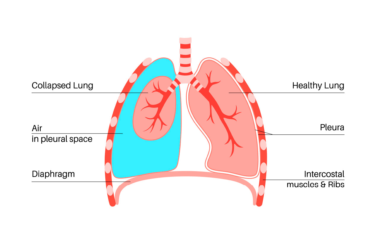 Pneumothorax Anatomical Illustration Home Decor Premium Quality Poster Print Choose Your Sizes - Bella Home Decor
