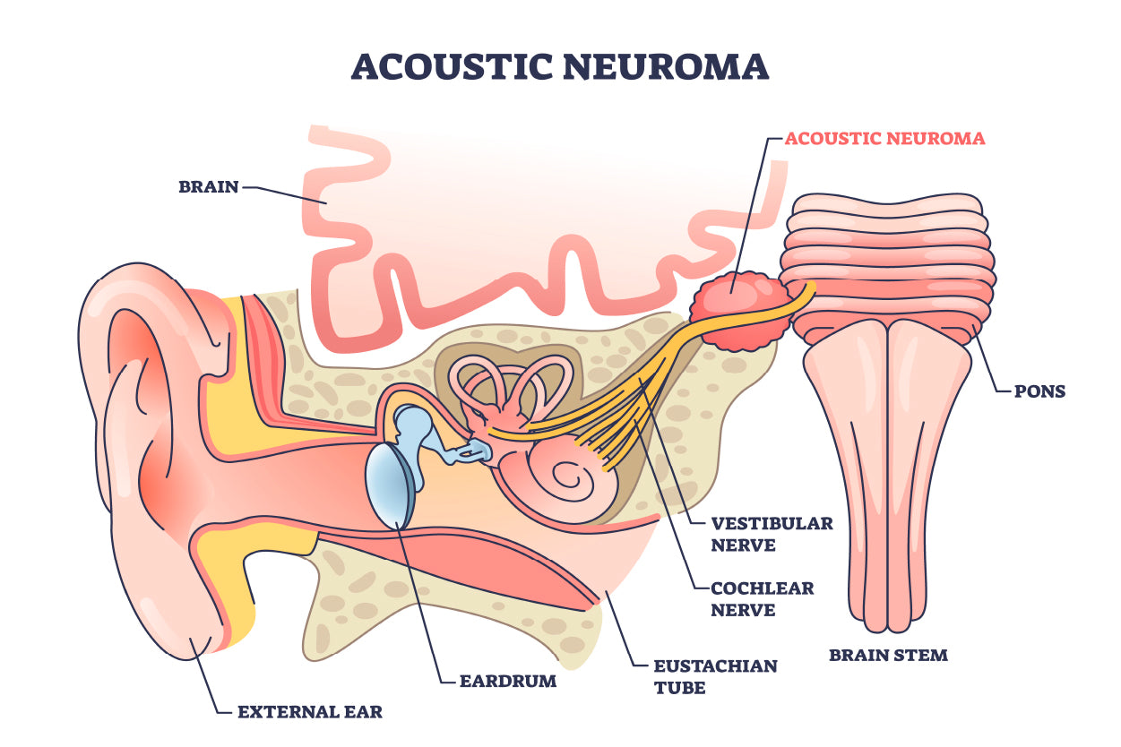 Acoustic Neuroma Home Decor Premium Quality Poster Print Choose Your Sizes - Bella Home Decor