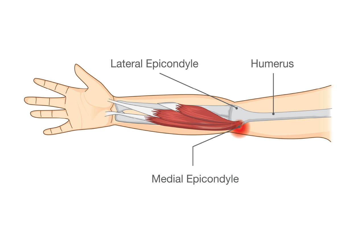Muscle Injury and Tear in Tendon at Elbow Area Home Decor Premium Quality Poster Print Choose Your Sizes - Bella Home Decor
