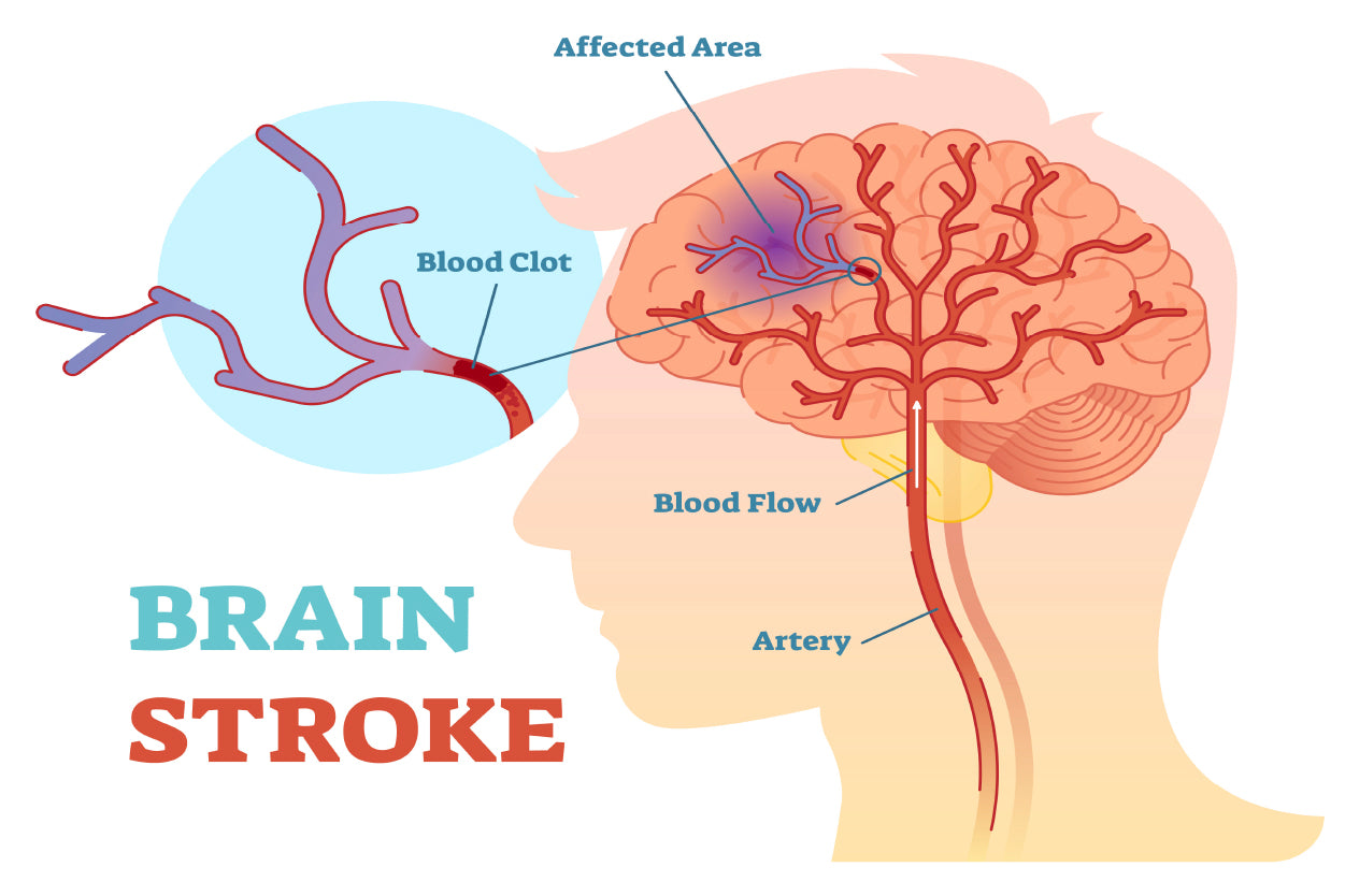 Brain Stroke Anatomical Vector Diagram Home Decor Premium Quality Poster Print Choose Your Sizes - Bella Home Decor