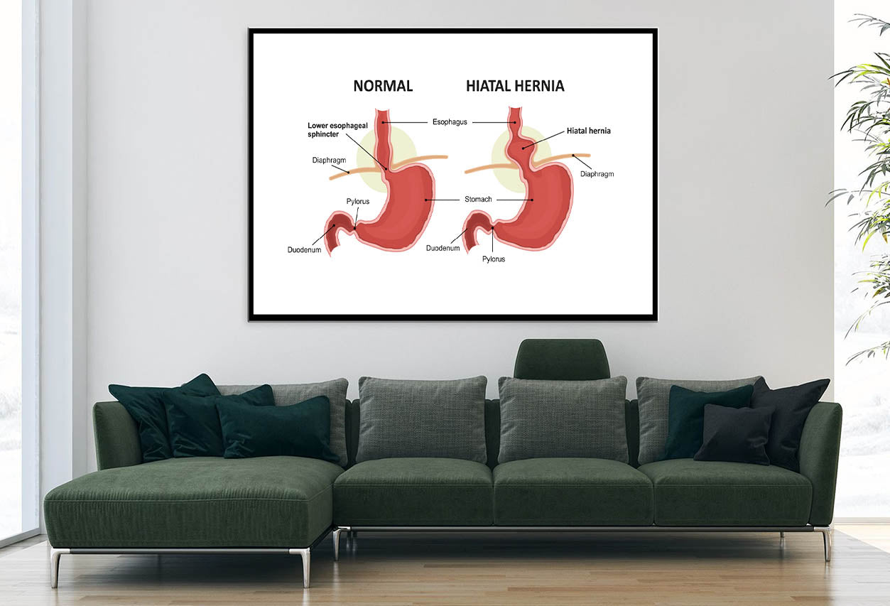 Hiatal Hernia & Normal Anatomy of The Stomach Home Decor Premium Quality Poster Print Choose Your Sizes