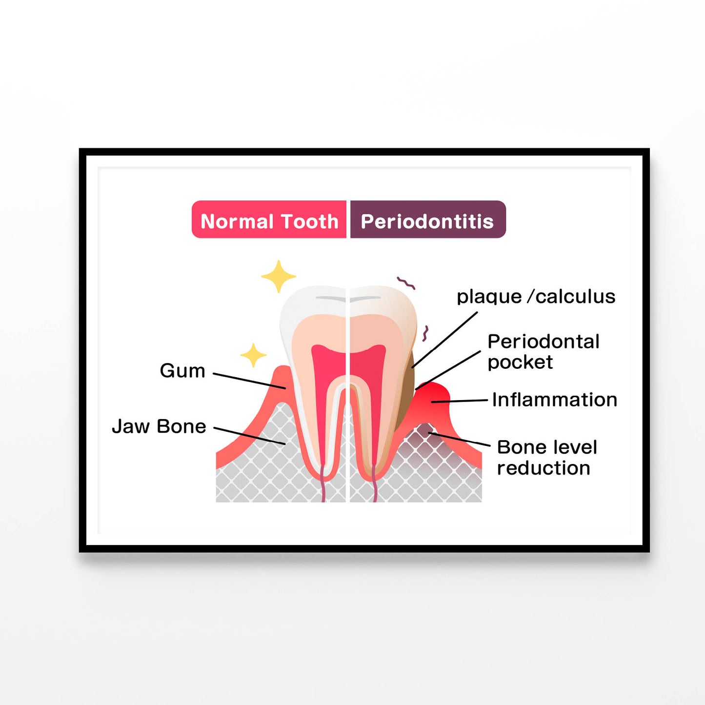 Normal Teeth & Periodontal Disease Home Decor Premium Quality Poster Print Choose Your Sizes