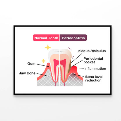 Normal Teeth & Periodontal Disease Home Decor Premium Quality Poster Print Choose Your Sizes