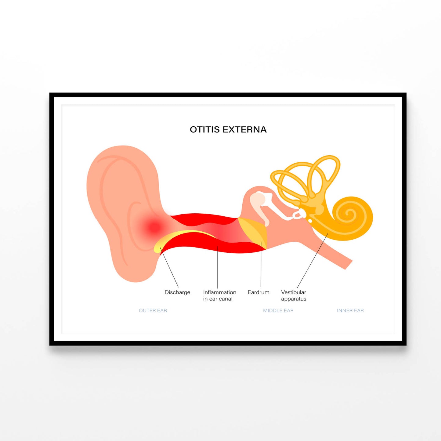 Swimmers Ear Otitis Illustration Home Decor Premium Quality Poster Print Choose Your Sizes