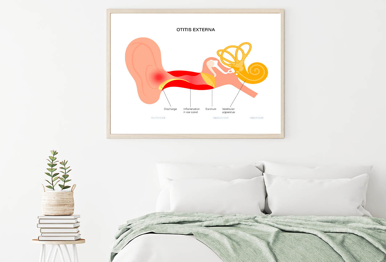 Swimmers Ear Otitis Illustration Home Decor Premium Quality Poster Print Choose Your Sizes