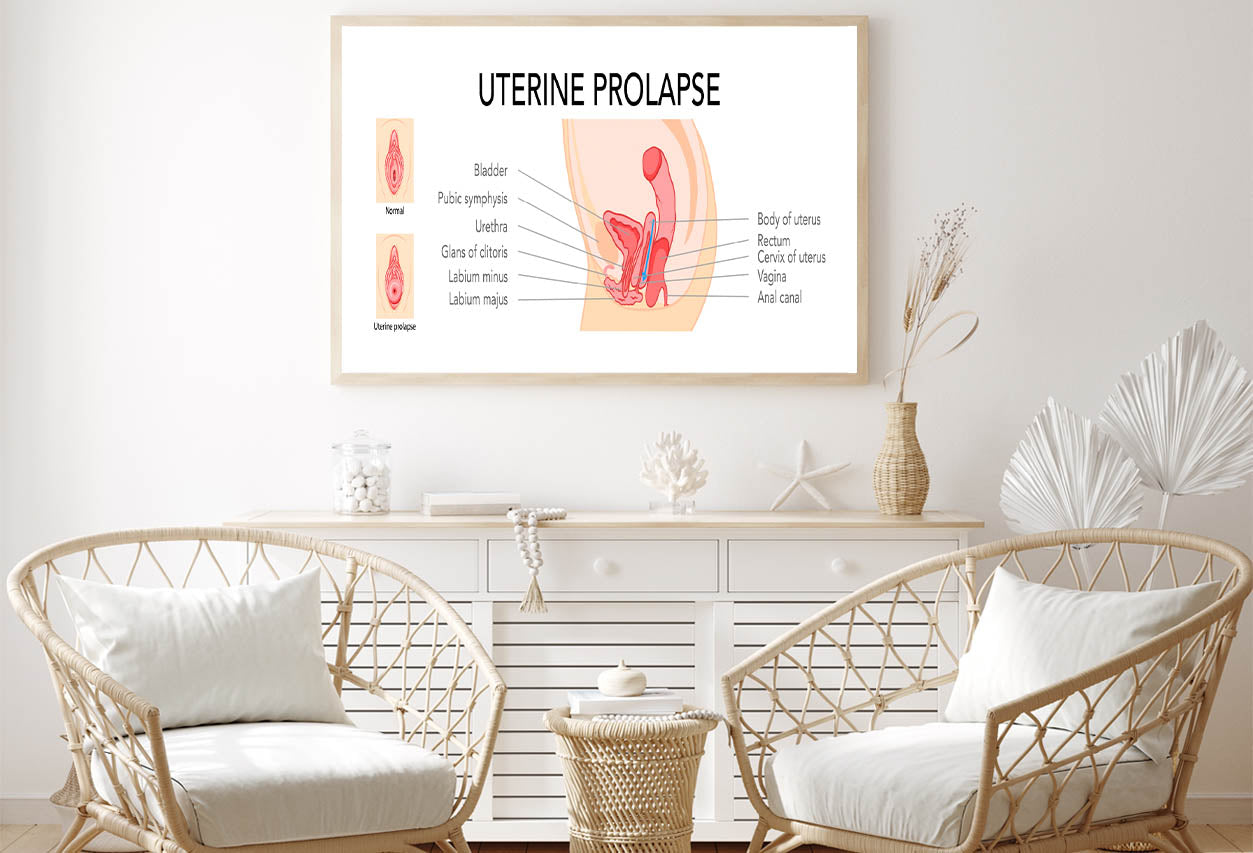 Uterine Prolapse Female Reproductive System Home Decor Premium Quality Poster Print Choose Your Sizes