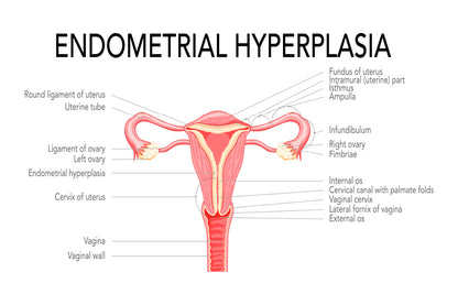 Endometrial Hyperplasia, Medical Diagram Home Decor Premium Quality Poster Print Choose Your Sizes