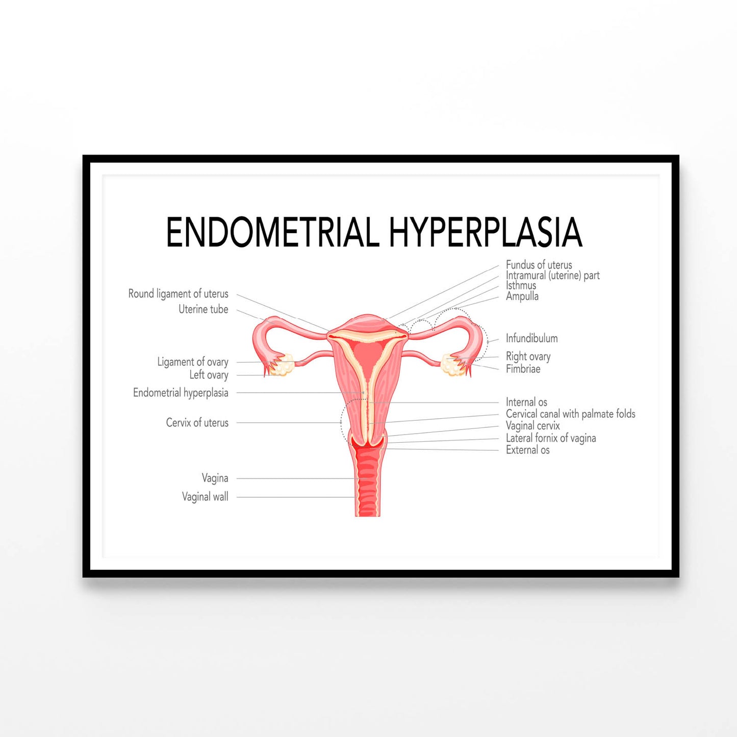 Endometrial Hyperplasia, Medical Diagram Home Decor Premium Quality Poster Print Choose Your Sizes