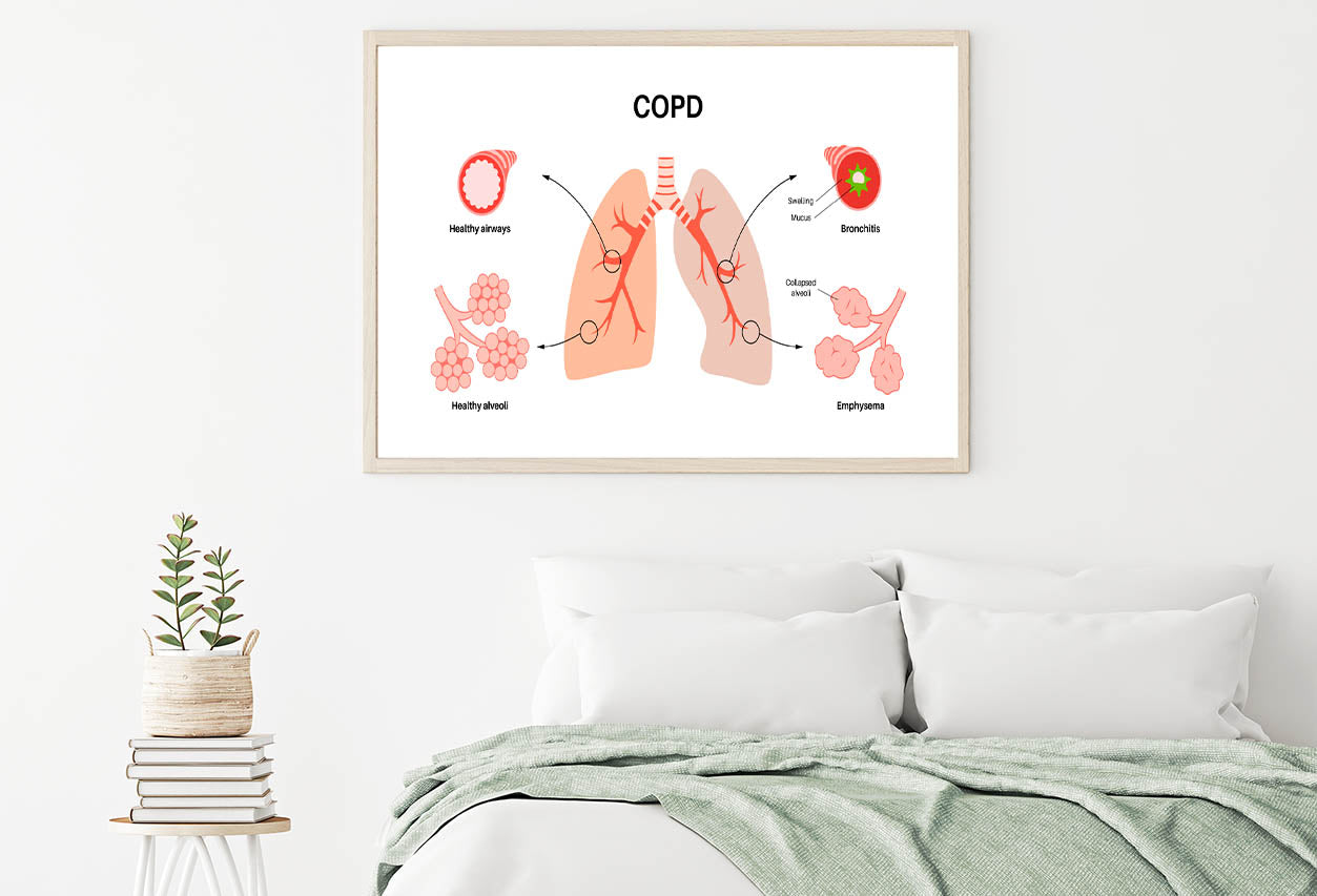 Chronic Obstructive Pulmonary Disease Home Decor Premium Quality Poster Print Choose Your Sizes