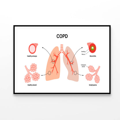 Chronic Obstructive Pulmonary Disease Home Decor Premium Quality Poster Print Choose Your Sizes