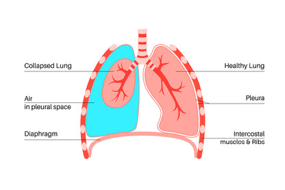 Pneumothorax Anatomical Illustration Home Decor Premium Quality Poster Print Choose Your Sizes