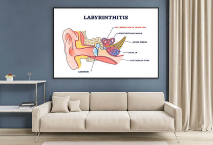 Labyrinthitis As Inner Ear Infection Diagram Home Decor Premium Quality Poster Print Choose Your Sizes