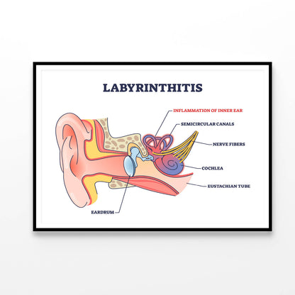 Labyrinthitis As Inner Ear Infection Diagram Home Decor Premium Quality Poster Print Choose Your Sizes