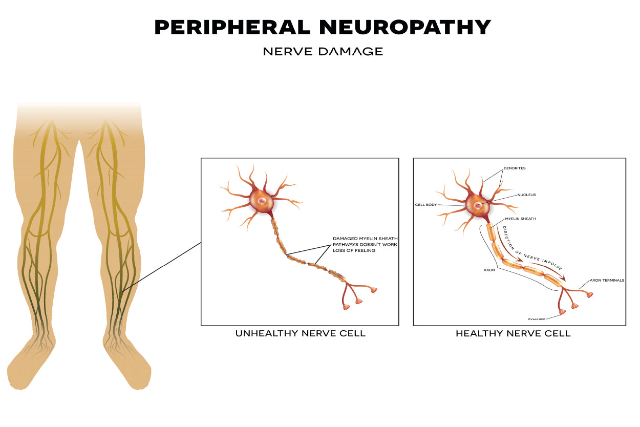 Neuropathy, Nerve Damage Illustration Home Decor Premium Quality Poster Print Choose Your Sizes