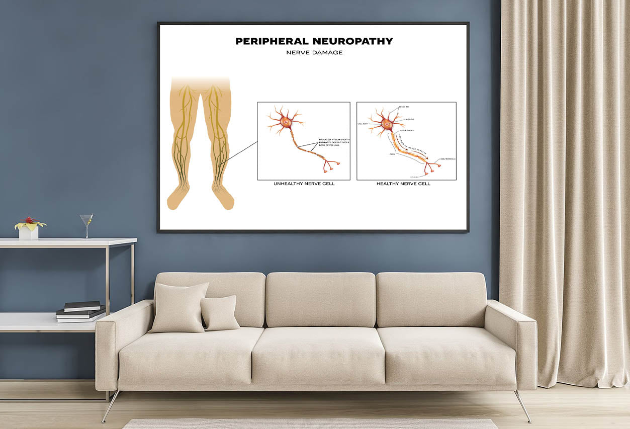 Neuropathy, Nerve Damage Illustration Home Decor Premium Quality Poster Print Choose Your Sizes