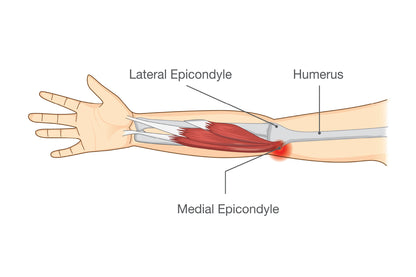 Muscle Injury and Tear in Tendon at Elbow Area Home Decor Premium Quality Poster Print Choose Your Sizes